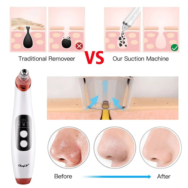 The Blackhead Remover Pro