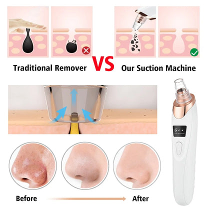 The Blackhead Remover